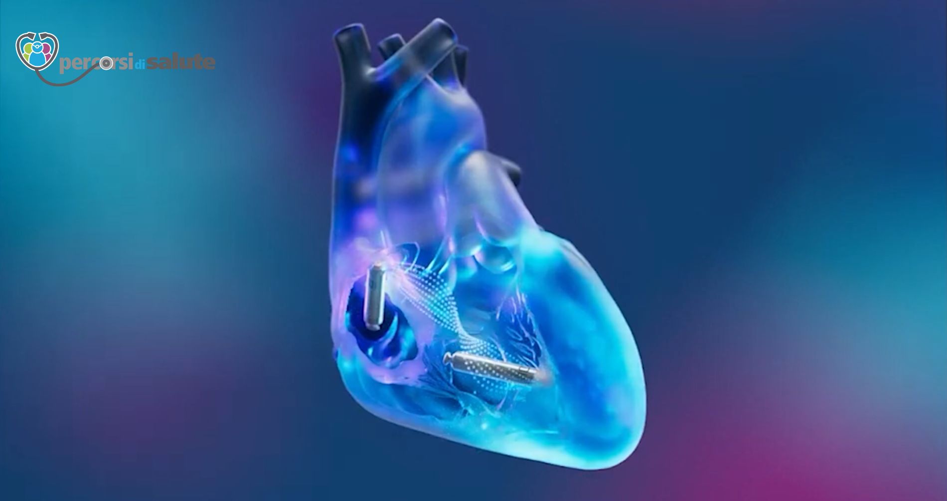 Peacemaker senza fili 